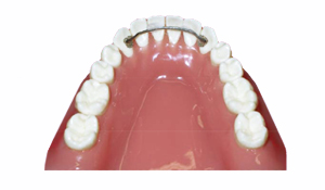 Bonded-(Fixed)-Retainer