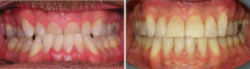 Surgical Orthodontic Correction of an Underbite